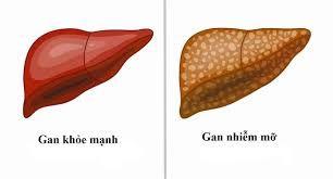 Ăn khoai lang hấp mỗi ngày, người phụ nữ hoảng hốt khi nhận kết quả khám gan